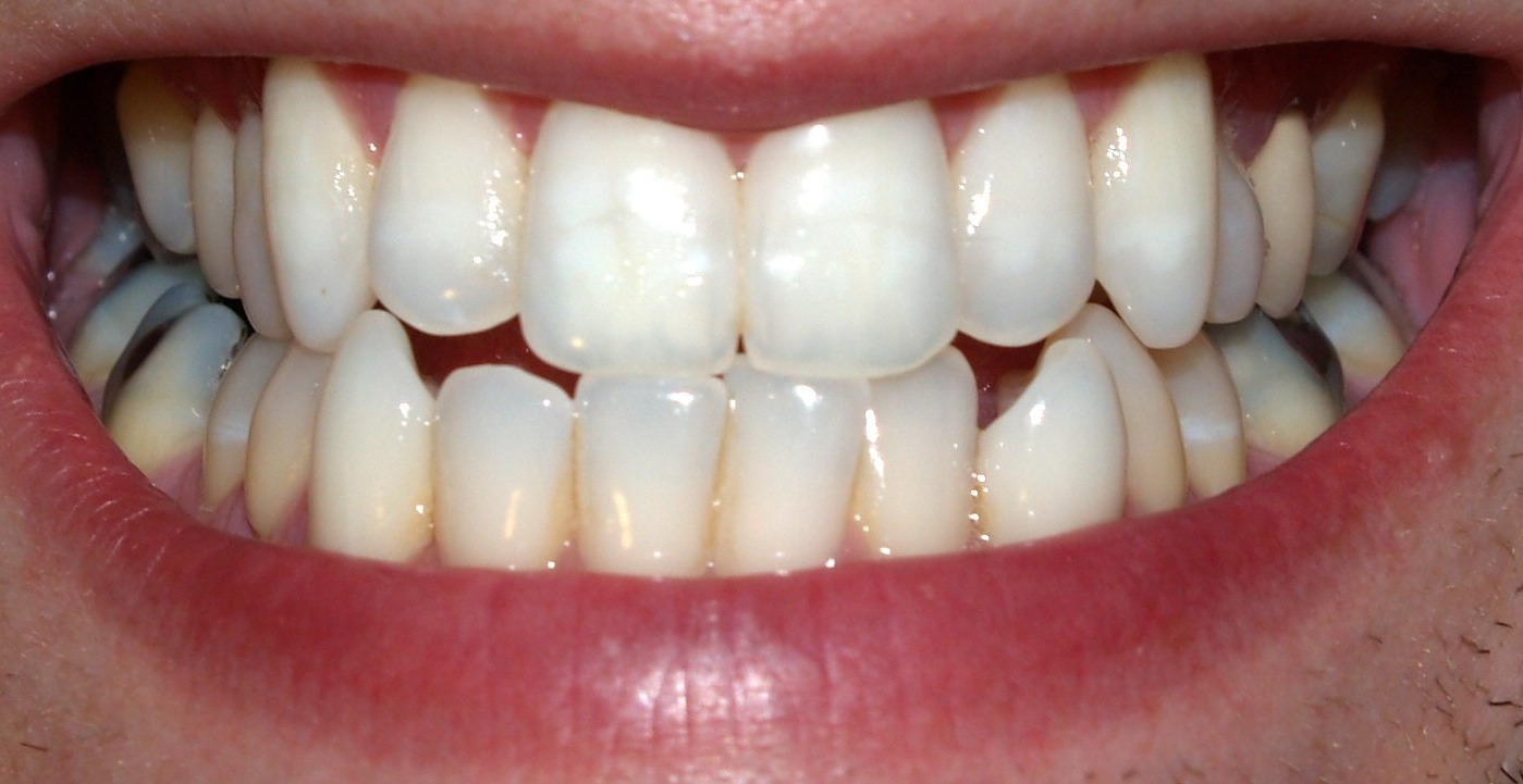 dark gums