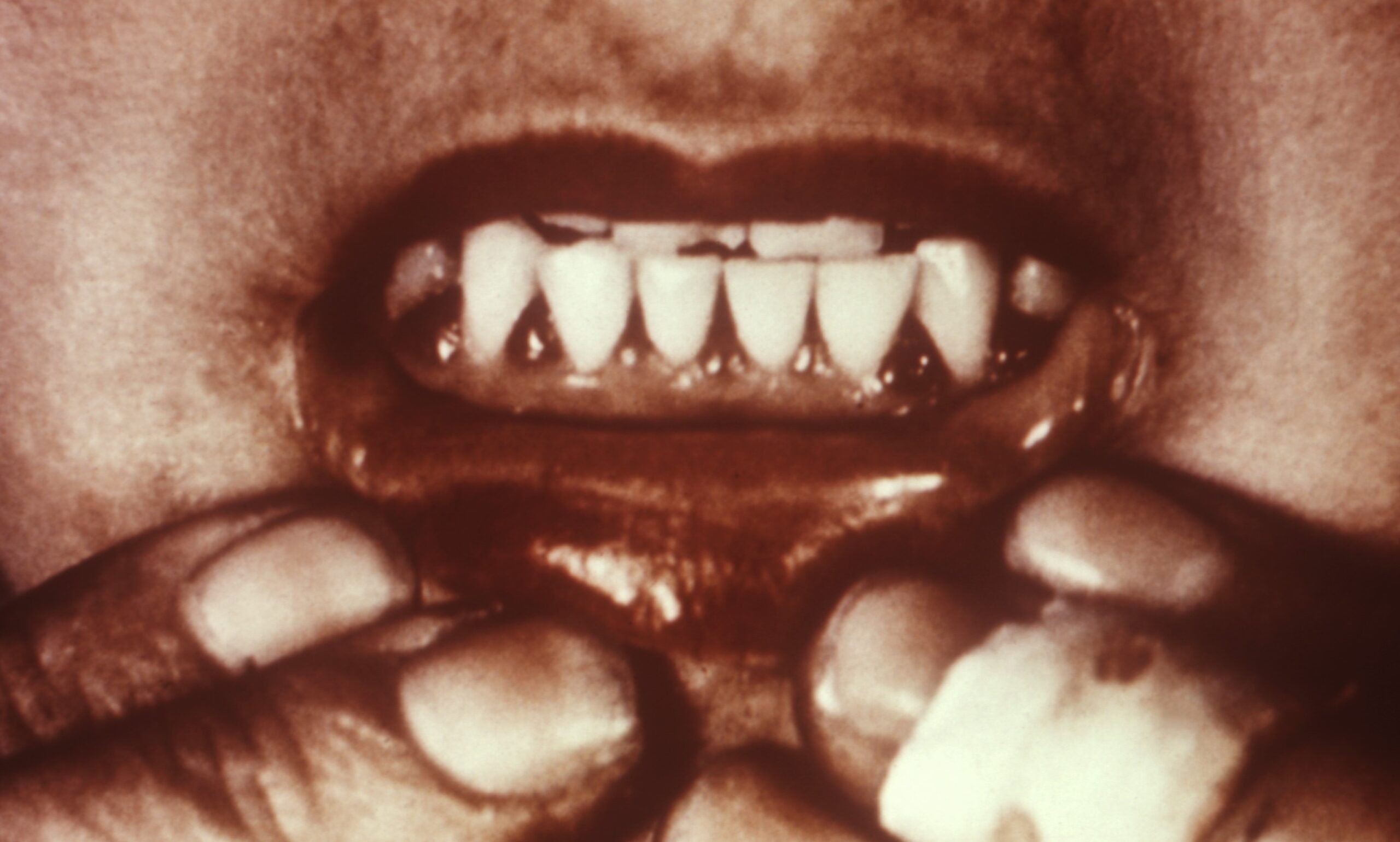 Understanding Dark Gums: What Do They Mean?